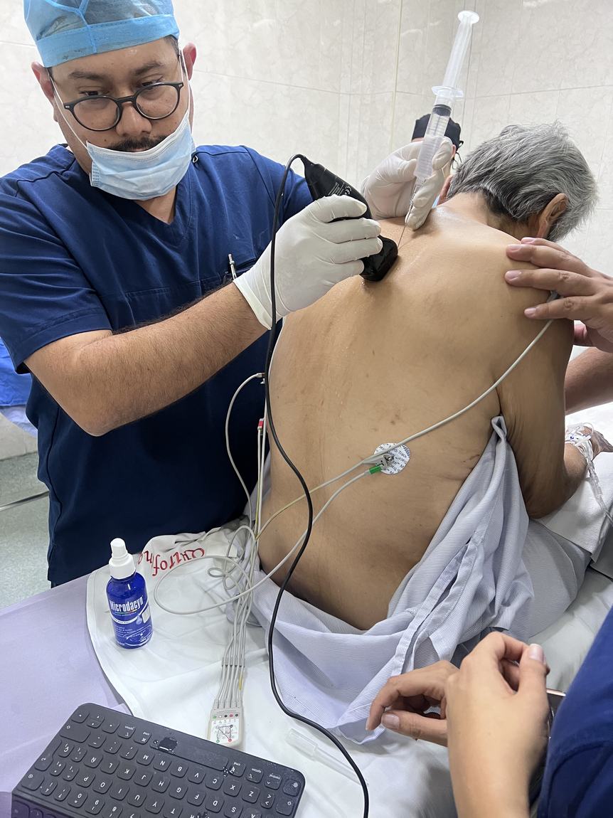 Aplicación de la anestesia local en el costado antes de la pleuroscopia