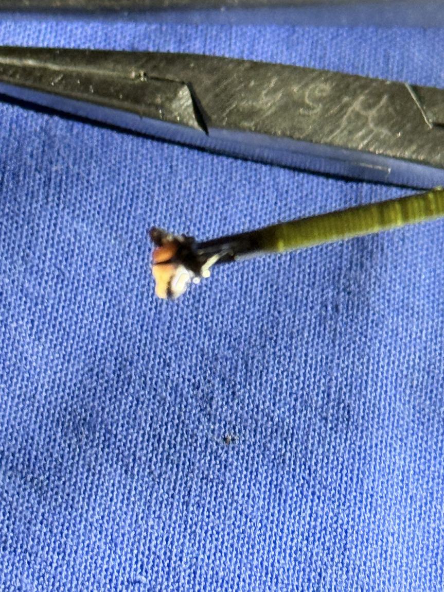 Pinza sosteniendo un fragmento pequeño de tejido pleural sobre un campo quirúrgico azul
