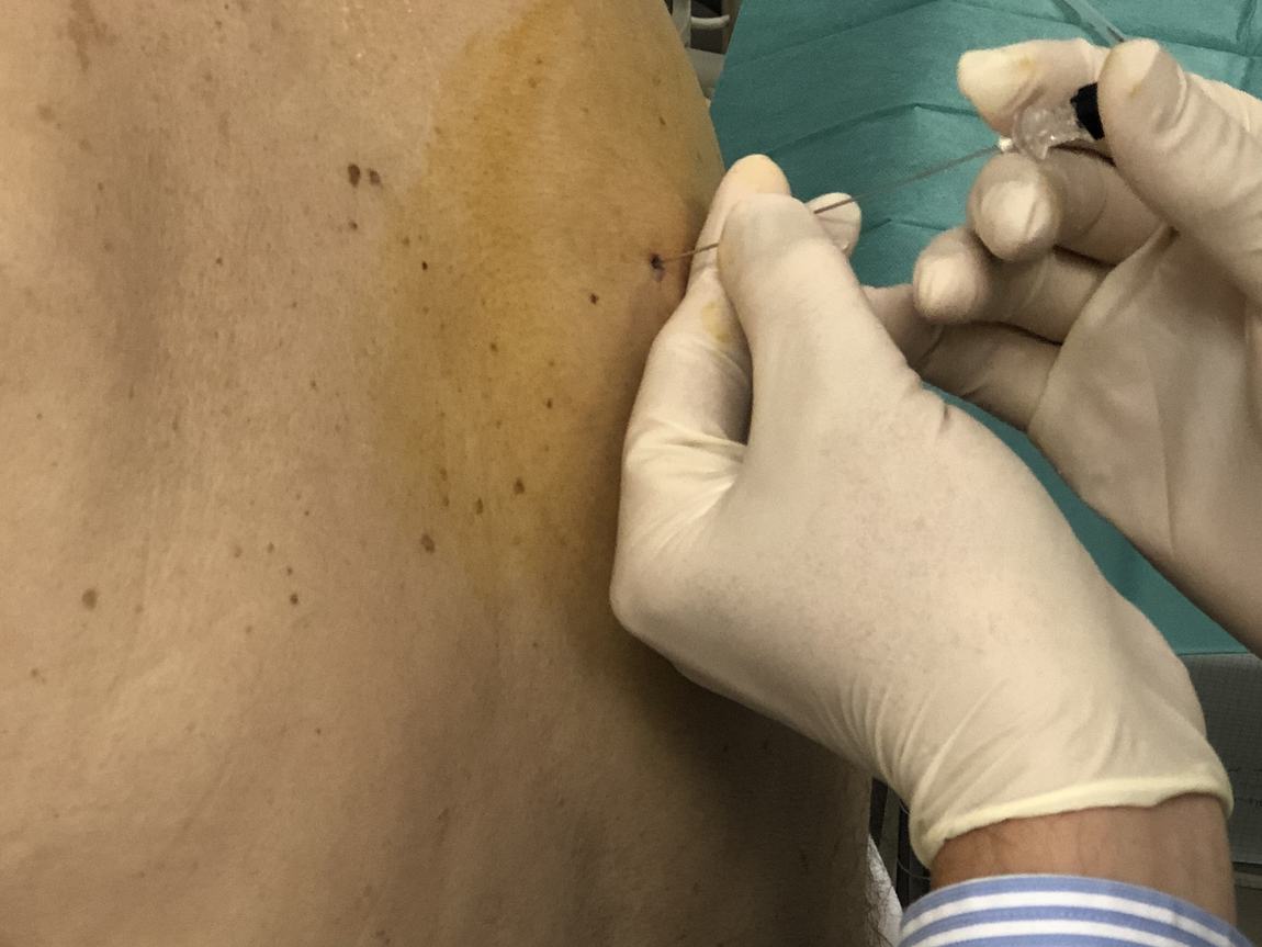 Toma de biopsia pleural con aguja a través de la piel del costado