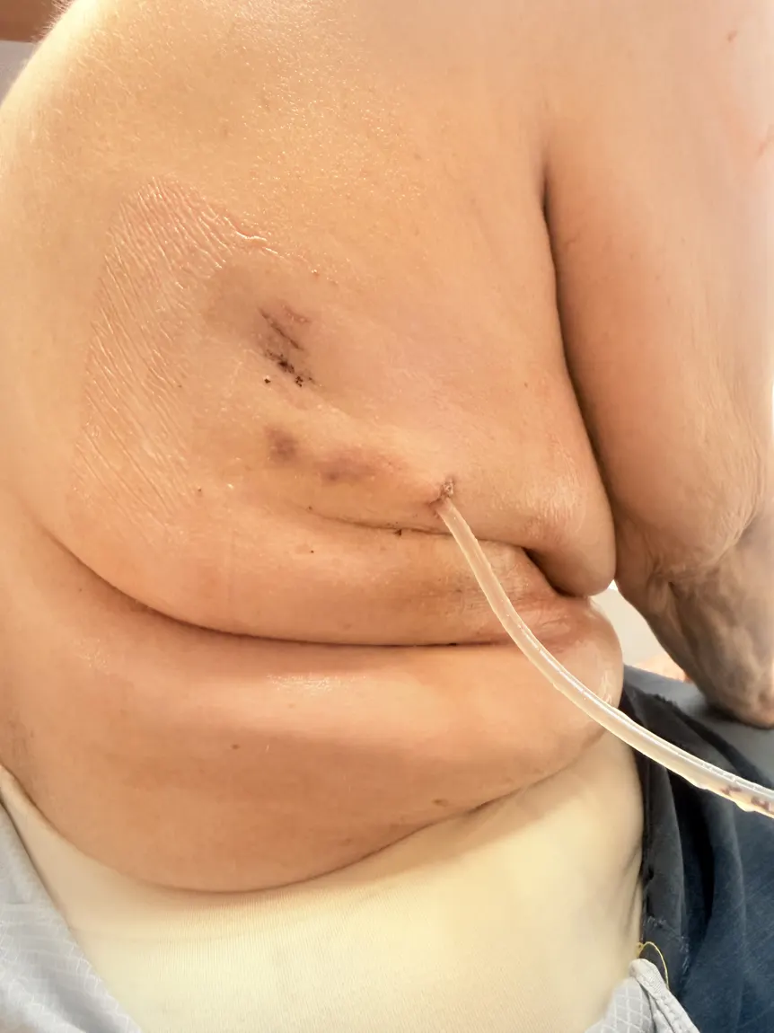 Catéter pleural tunelizado saliendo de la piel en el costado