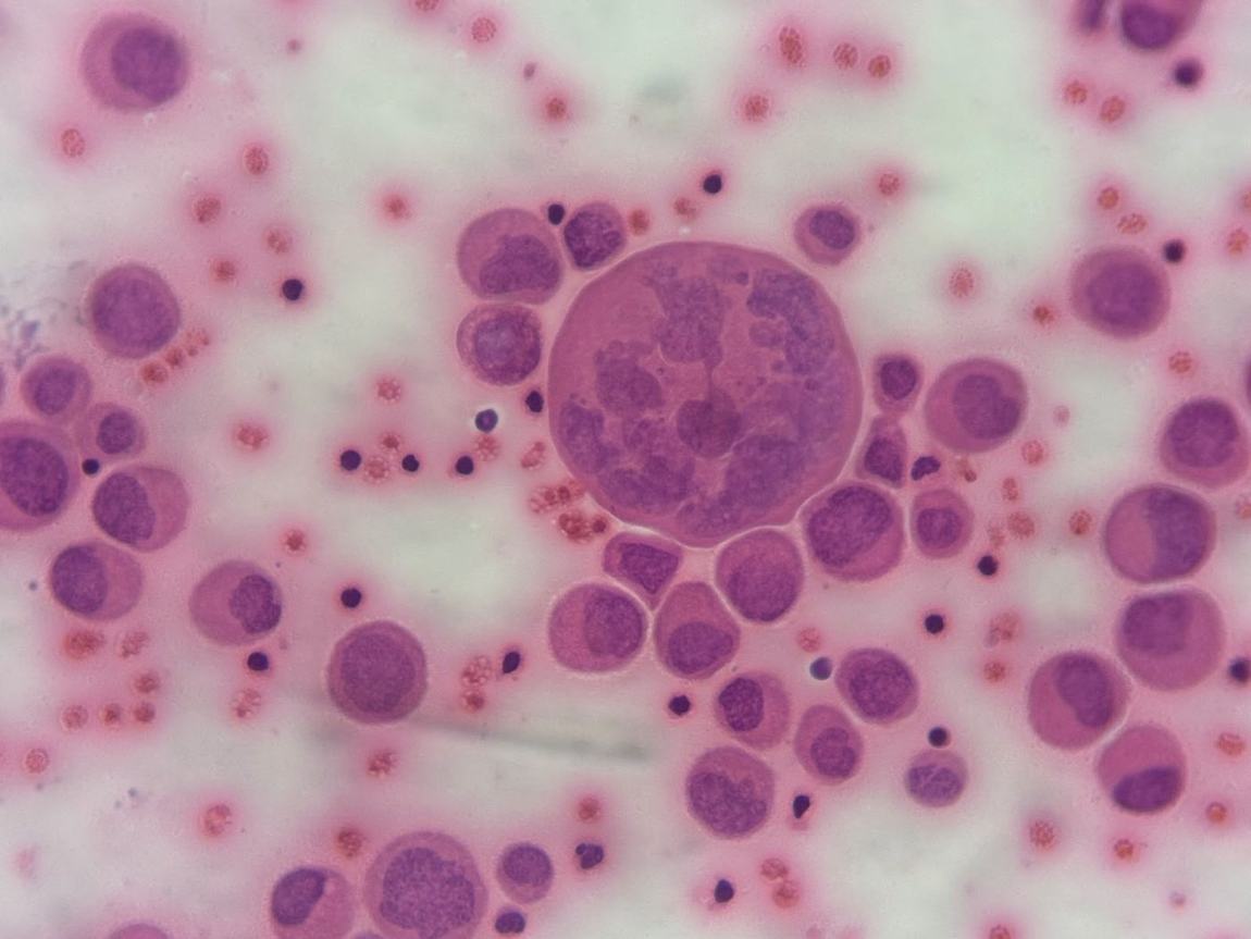 Vista al microscopio de células del líquido pleural teñidas de rosa y morado