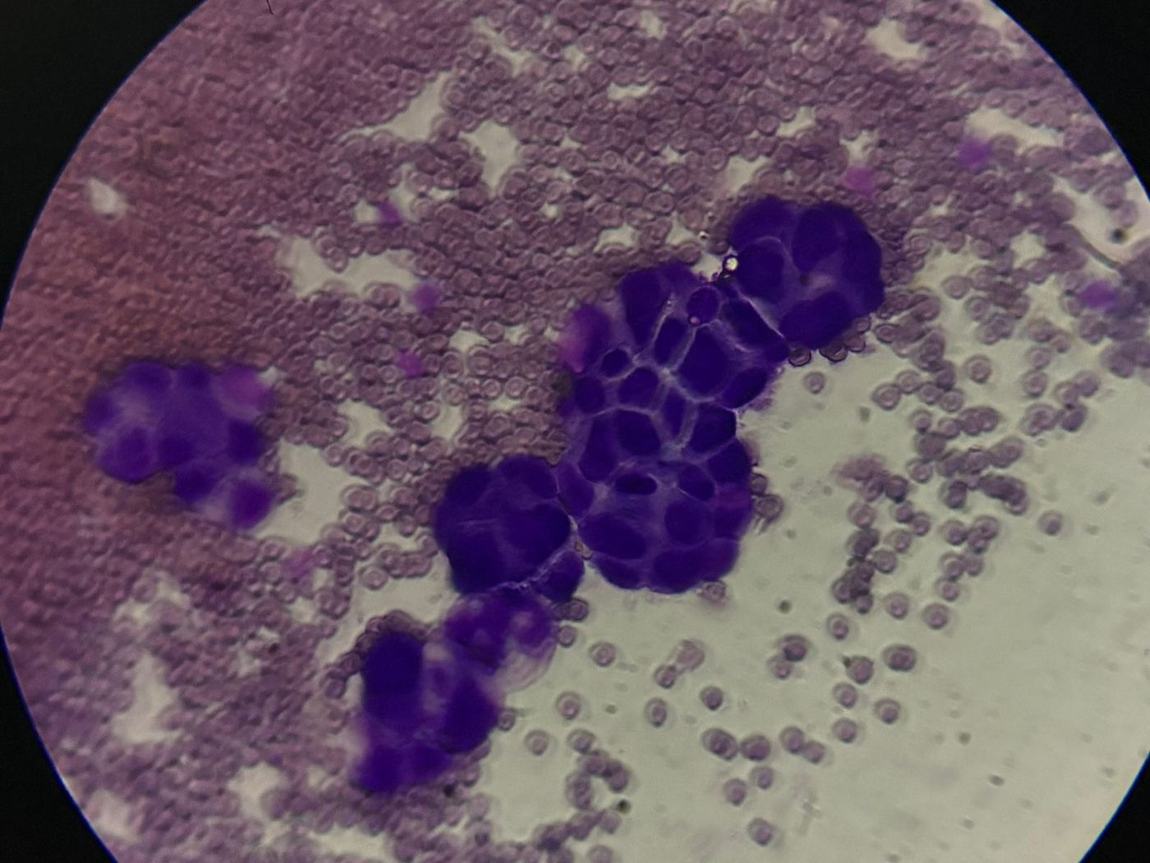 Citología del líquido pleural vista al microscopio, con células tumorales agrupadas entre las células normales