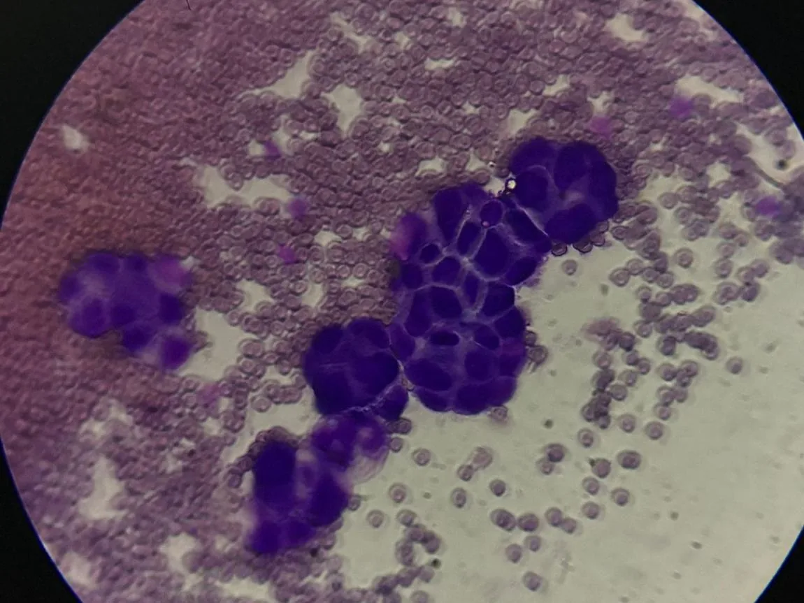 Citología del líquido pleural con células tumorales