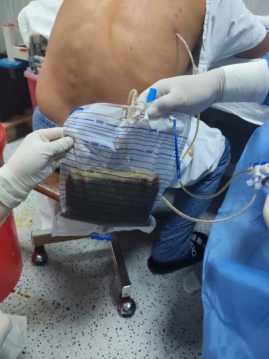 Bolsa de drenaje con líquido pleural muy oscuro, conectada a un catéter