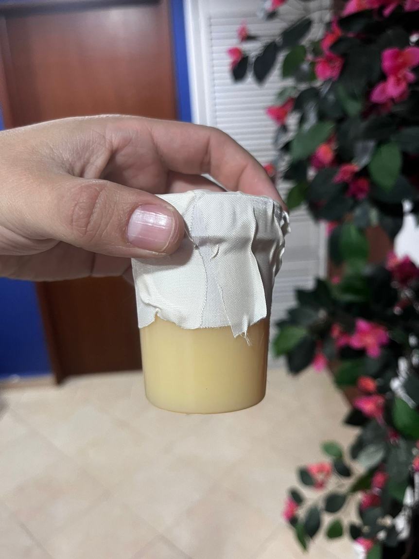 Frasco con líquido pleural de color amarillo claro y transparente