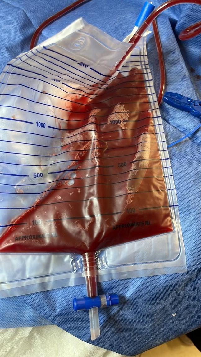 Bolsa de drenaje con líquido pleural de color rojo oscuro