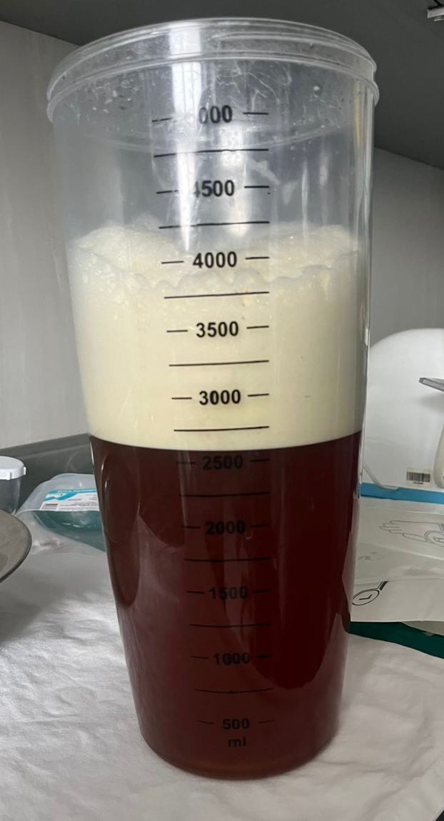 Frasco graduado con líquido pleural oscuro y una capa lechosa en la parte superior