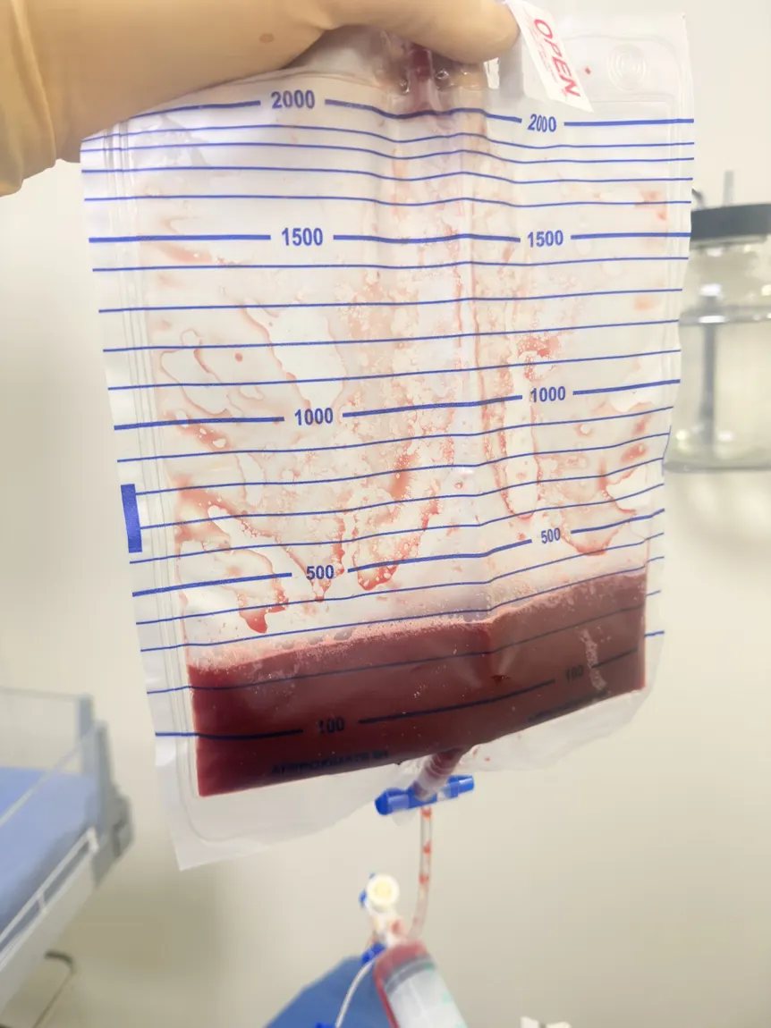 Bolsa de drenaje graduada con líquido pleural rojo oscuro y restos sanguinolentos en las paredes