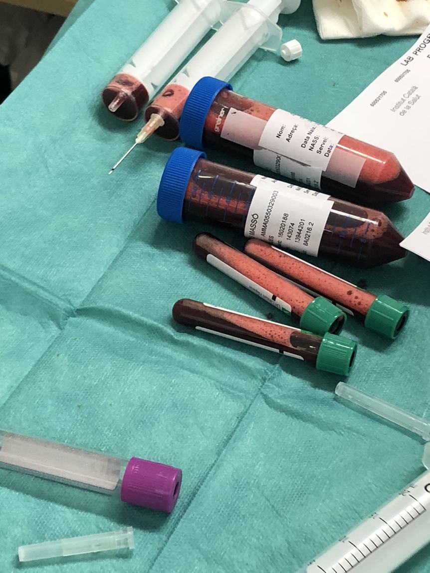 Tubos de laboratorio con muestras de líquido pleural sobre el campo estéril