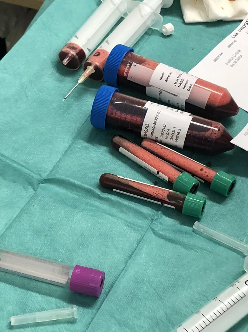 Tubos con muestras de líquido pleural preparados para enviar al laboratorio