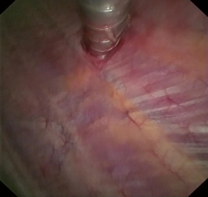 Vista endoscópica al entrar al espacio pleural: el trocar en la parte superior y la pleura parietal lisa, a través de la cual se transparentan las costillas