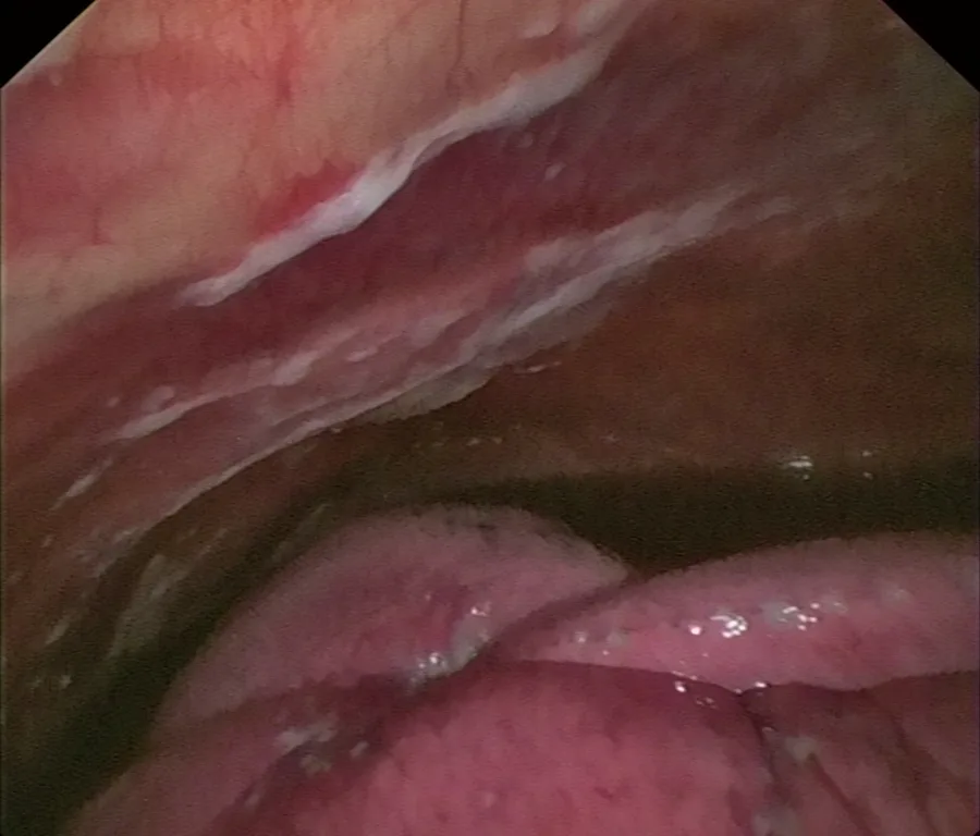Vista por pleuroscopia de bandas blancas de fibrina sobre la pleura, con la superficie del pulmón en la parte inferior
