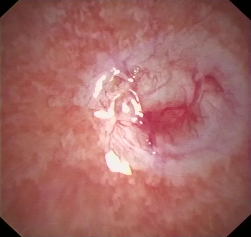 Vista por pleuroscopia de una zona blanquecina y engrosada de la pleura, con vasos irregulares alrededor; lesiones que resultaron malignas