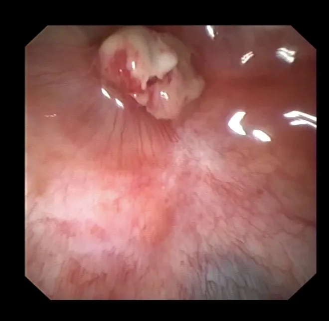 Vista por pleuroscopia de un nódulo blanquecino que sobresale de la pleura, con vasos que convergen hacia él; la biopsia confirmó que era maligno