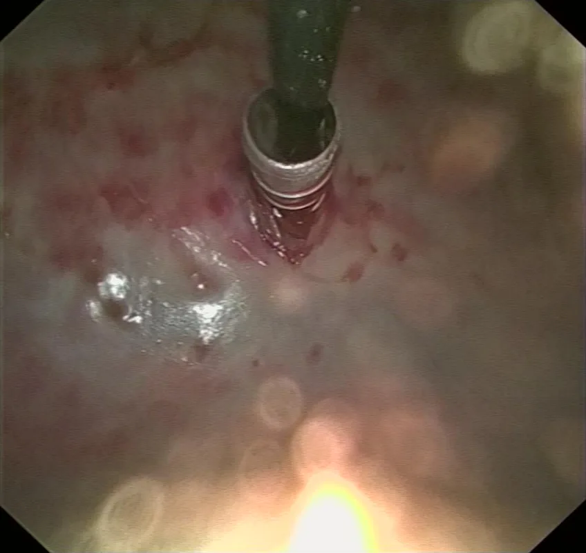 Vista por pleuroscopia de la pleura inflamada, enrojecida y con puntos de sangrado, con el trocar de entrada en la parte superior
