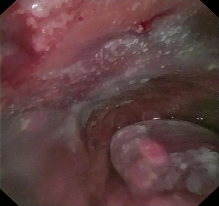 Vista por pleuroscopia de talco recién espolvoreado, que forma una capa blanca granulosa sobre la pleura y el pulmón