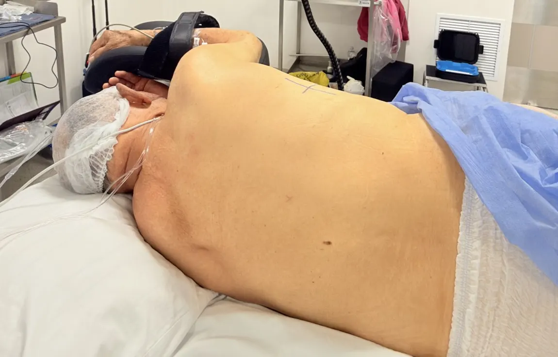 Paciente acostado de lado sobre la mesa, con el brazo por encima de la cabeza, puntas nasales de oxígeno y marcas en la piel del costado donde se hará la entrada
