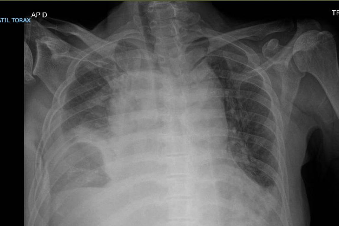 Radiografía de tórax que muestra un derrame pleural: el líquido borra el ángulo costofrénico y ocupa la parte baja del hemitórax