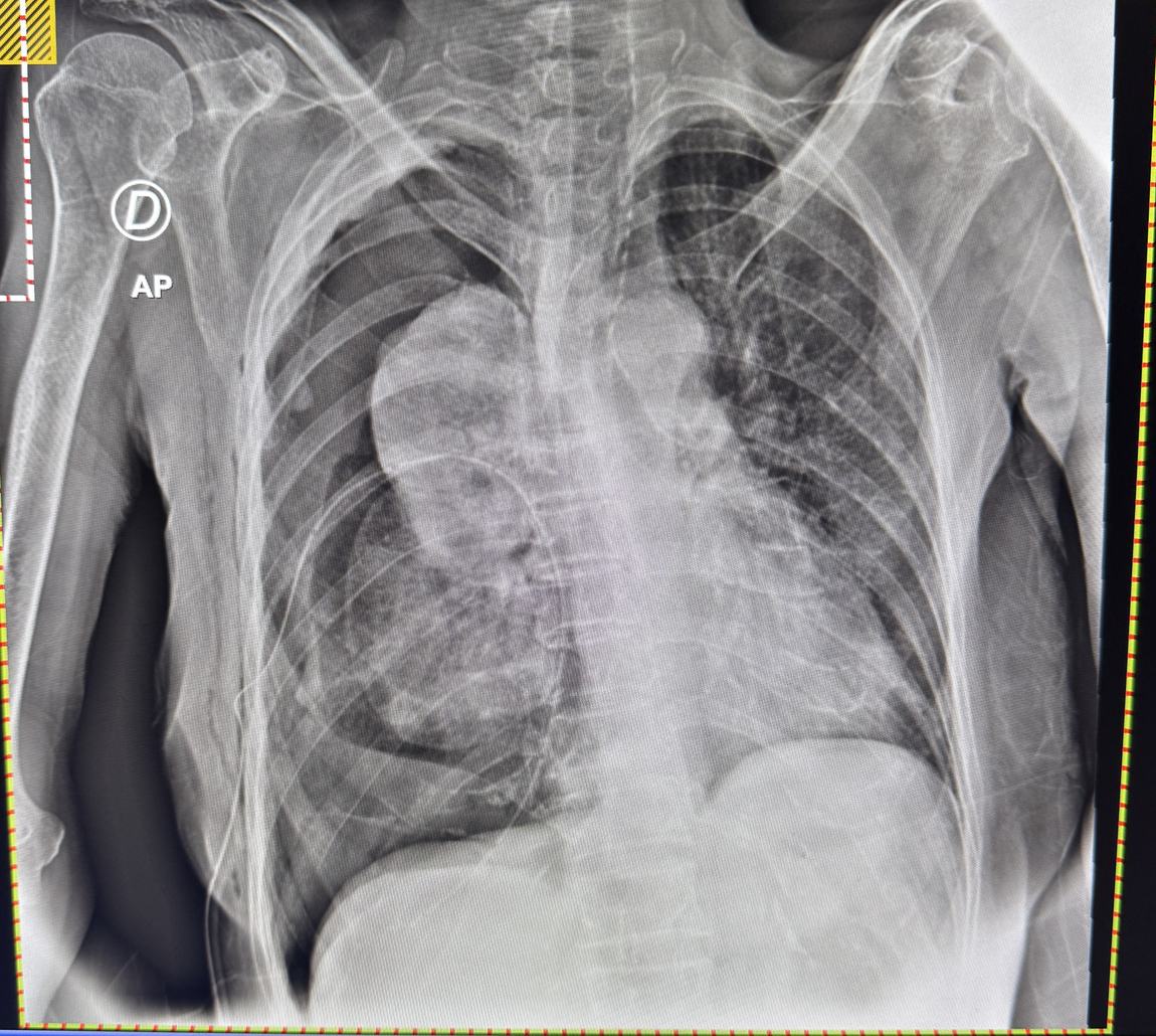 Radiografía de tórax de un pulmón atrapado, que no logra expandirse tras drenar el líquido