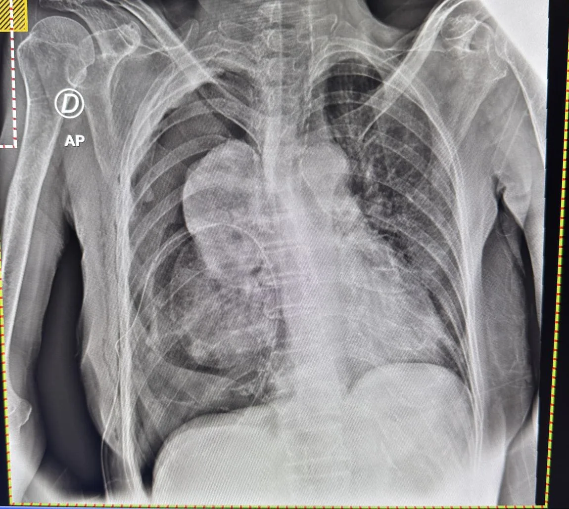 Radiografía de tórax de un pulmón atrapado, que no logra expandirse tras drenar el líquido