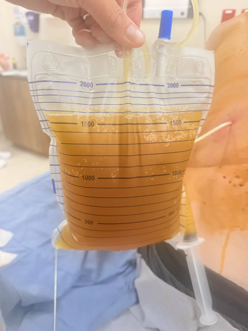 Bolsa graduada con más de un litro de líquido pleural