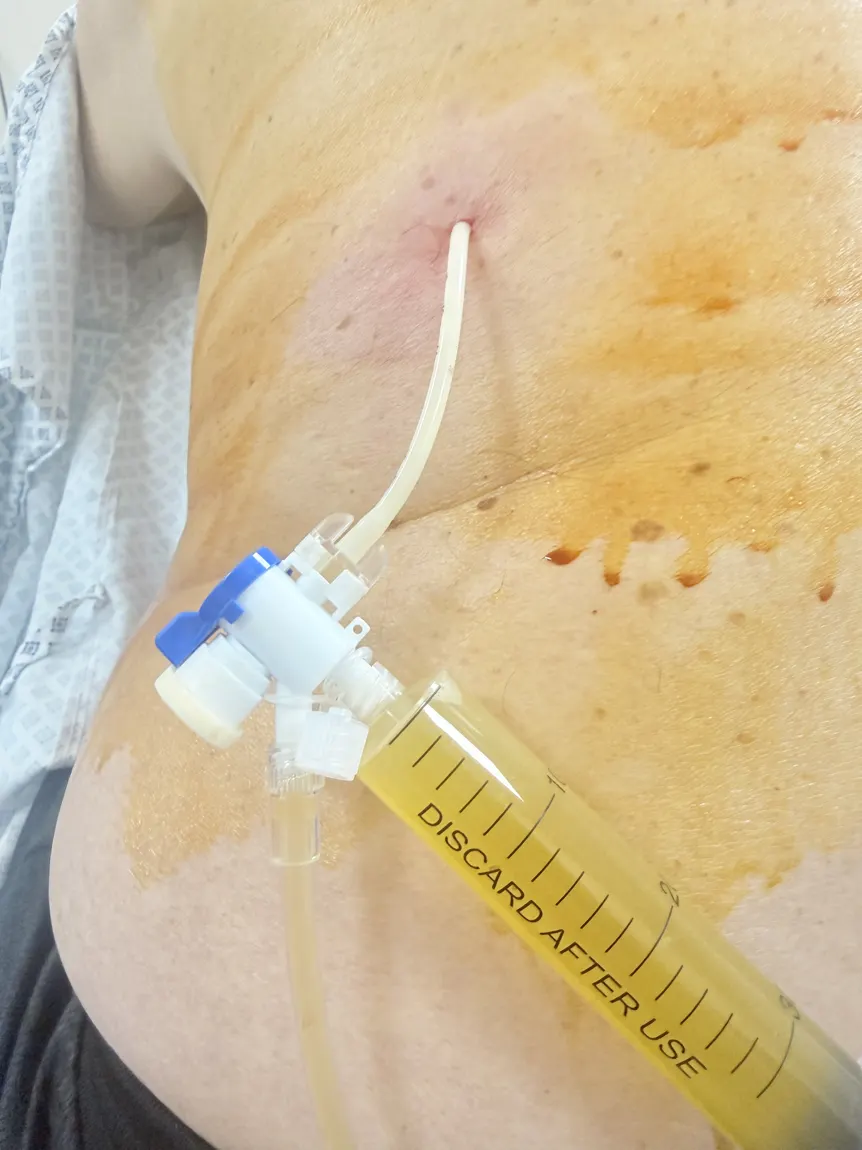 Acercamiento del catéter delgado de toracocentesis en la espalda, conectado a una llave de tres vías y a una jeringa con líquido pleural