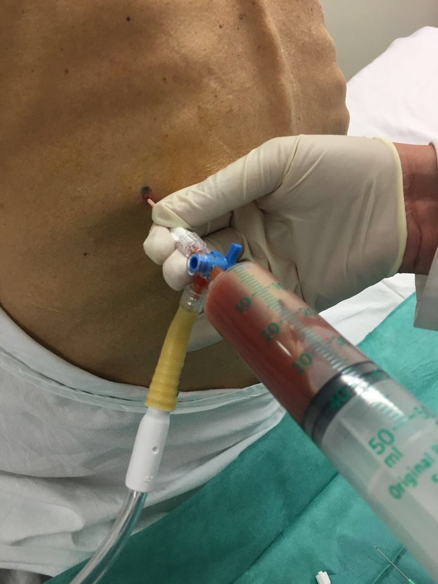 Jeringa conectada al catéter, extrayendo líquido pleural
