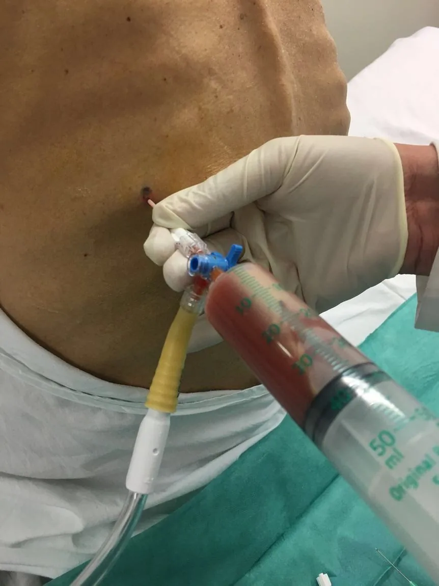 Jeringa conectada al catéter, extrayendo líquido pleural