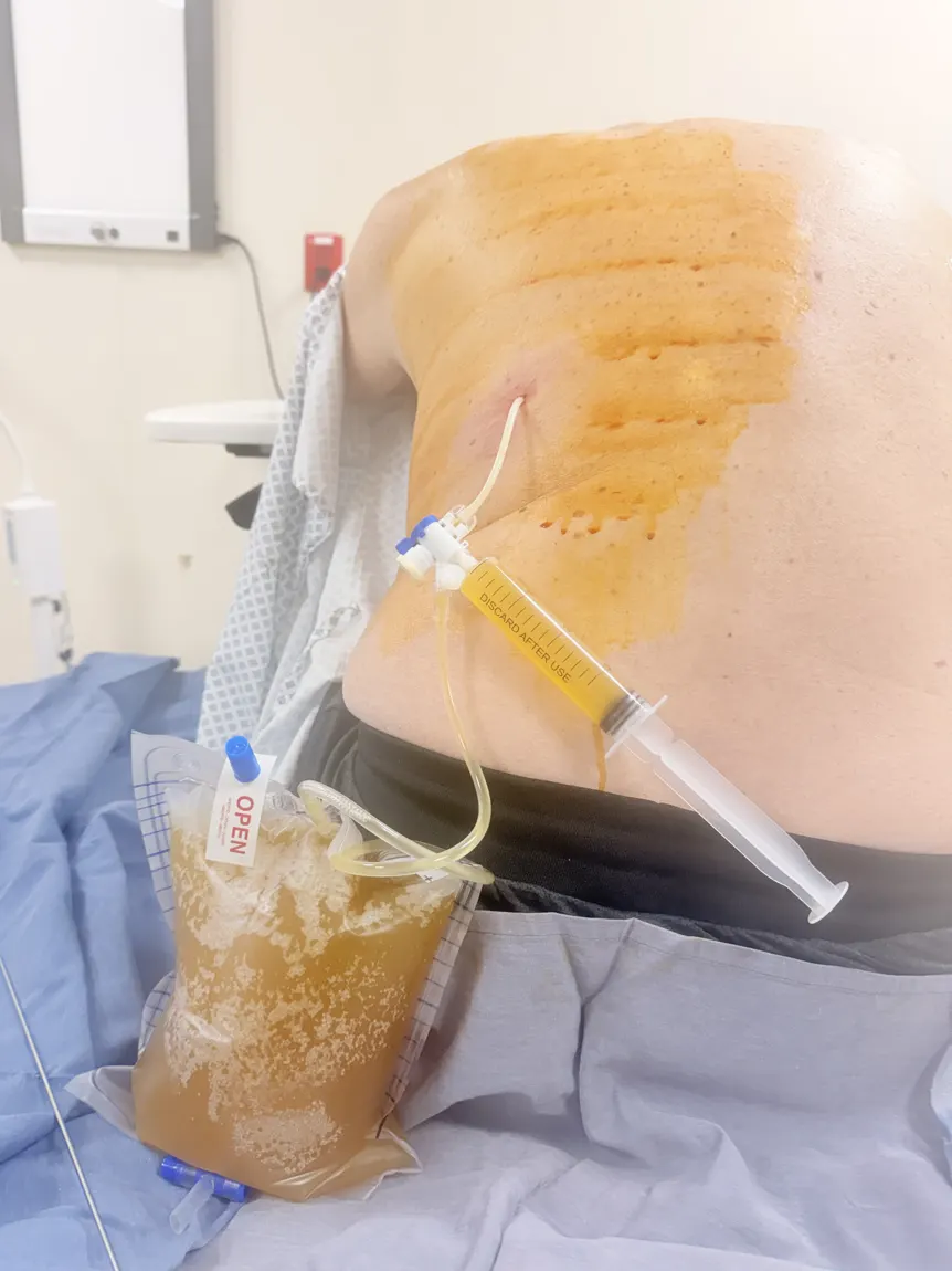 Toracocentesis evacuadora en curso por la espalda con bolsa recolectora
