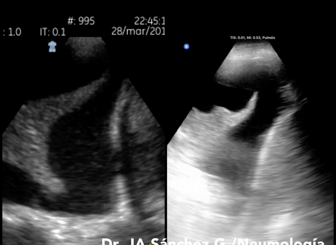 Imagen de ultrasonido torácico con derrame pleural