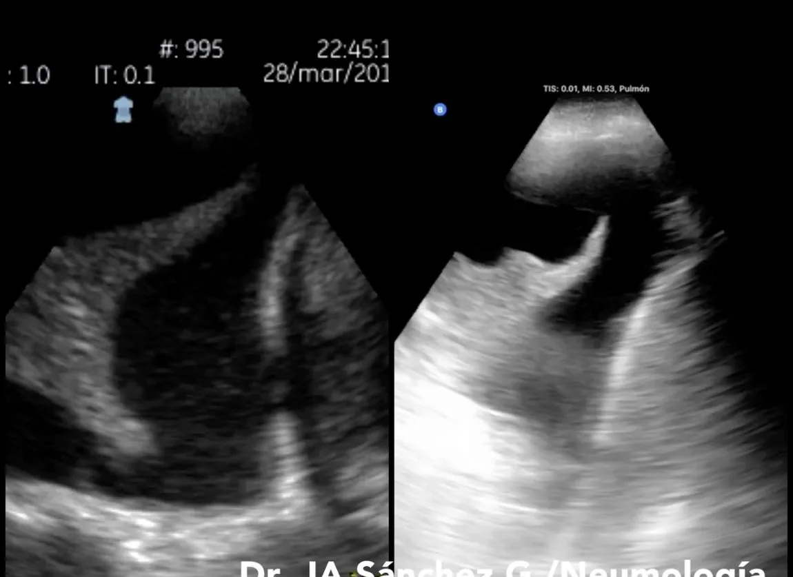 Imagen de ultrasonido de un derrame pleural